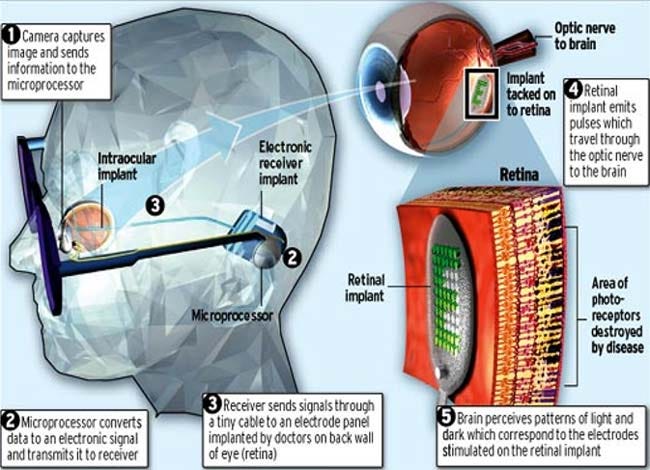 Promising bionic eye technology for improved vision