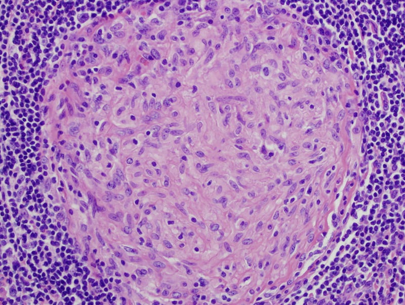 Granuloma structure in tuberculosis infection